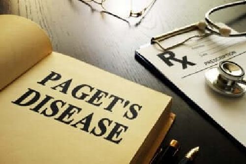 Choroba Pageta kości - co musisz o niej wiedzieć?