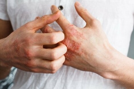Alergiczne Zapalenie Skory Na Czym Polega Ta Choroba Krok Do Zdrowia