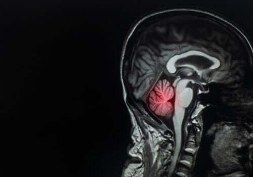 Przerzuty do mózgu: opis i leczenie tej choroby
