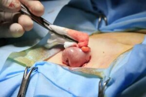 Kolostomia: na czym polega i jak się ją wykonuje?