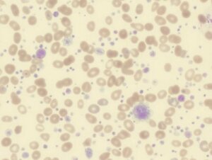 Nadpłytkowość - objawy, przyczyny i leczenie