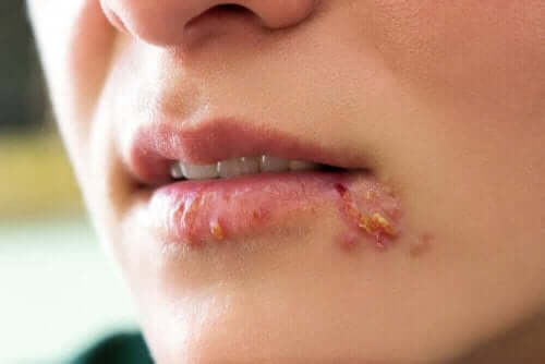 Opryszczka na ustach - wirusy opryszczki pospolitej