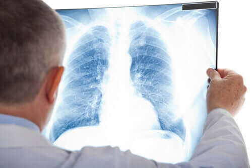 Zdjęcie RTG płuc - zapalenie opłucnej