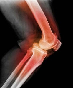 Zwichnięcie rzepki - dowiedz się wszystkiego na ten temat