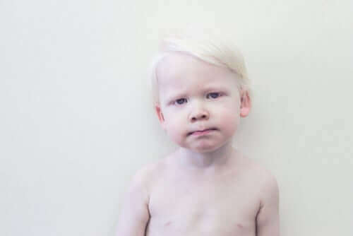 Dziecko albinos