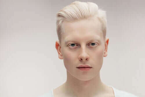Albinosi: co warto wiedzieć o albinizmie?