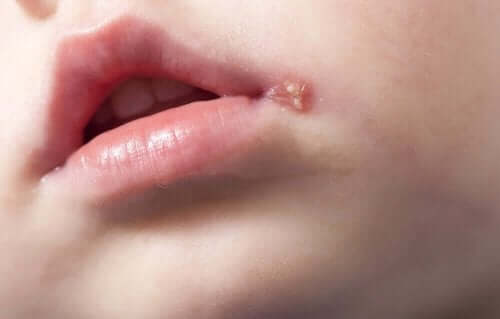 Opryszczka w kąciku ust