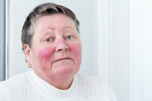 Rosacea czyli trądzik różowaty: objawy i przyczyny