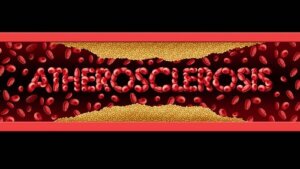 Arterioskleroza: objawy i leczenie