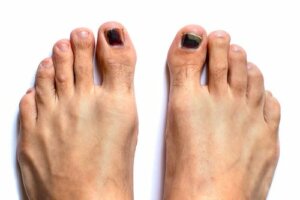 Czarne paznokcie u stóp: jak je leczyć?