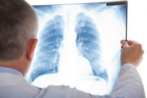 Płuca na zdjęciu RTG