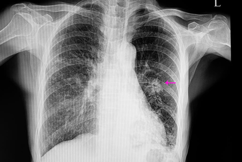Guzek płucny, czym jest i jak powstaje?