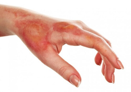 Martwica skóry: jak ją zdiagnozować?
