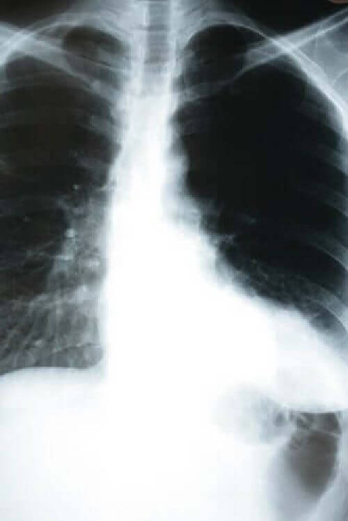 Jak zapalenie płuc wpływa na nasz organizm?