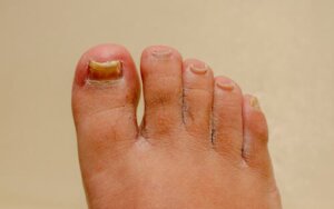 Grzybica paznokci dłoni i stóp: co mi pomoże?