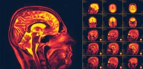 Czym jest neuroplastyczność mózgu?
