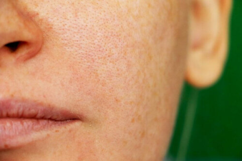 Melasma - naturalne sposoby na ciemne plamki na skórze