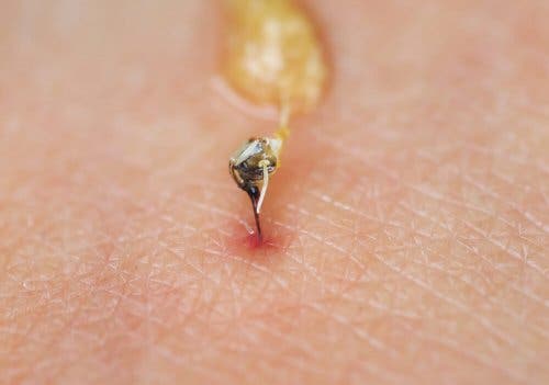 Żądło - użądlenie pszczoły