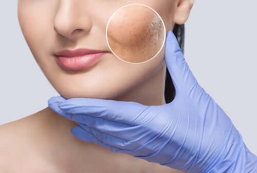 Soft Lift u dermatologa