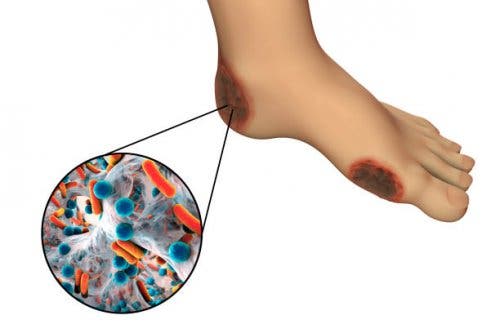 Gangrena stopy - rodzaje gangreny