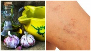 Naturalny sposób na żylaki z oliwy z oliwek i czosnku