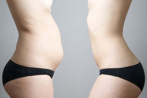 Tłuszcz na brzuchu i kriolipoliza - przed i po zabiegu