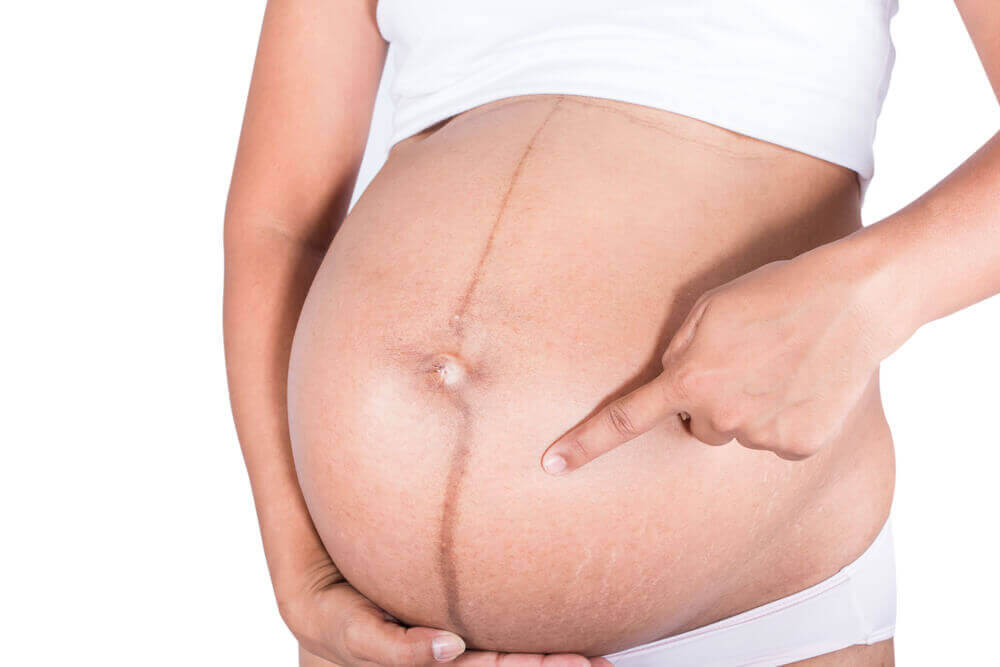 Wahania wagi i zmiany hormonalne prowadzą do powstawania rozstępów.