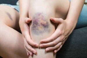 Co powoduje zakrzepowe zapalenie żył powierzchownych?