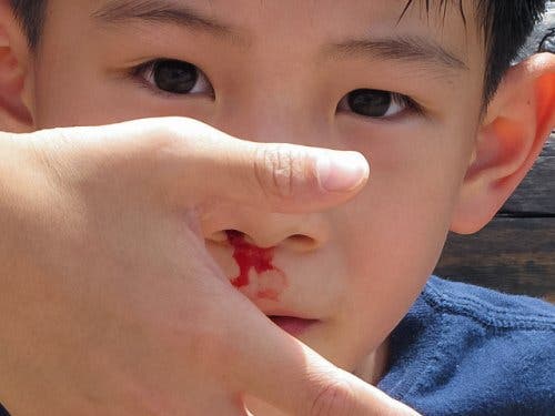 Krew lecąca z nosa chłopca
