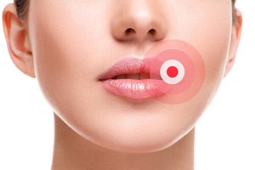 Opryszczka na ustach - jak szybko zwalczyć opryszczkę?