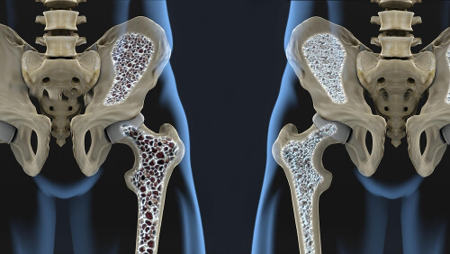 Zmniejszona gęstość kości w osteoporozie