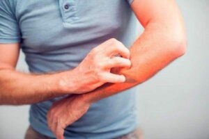 5 naturalnych środków łagodzących swędzenie