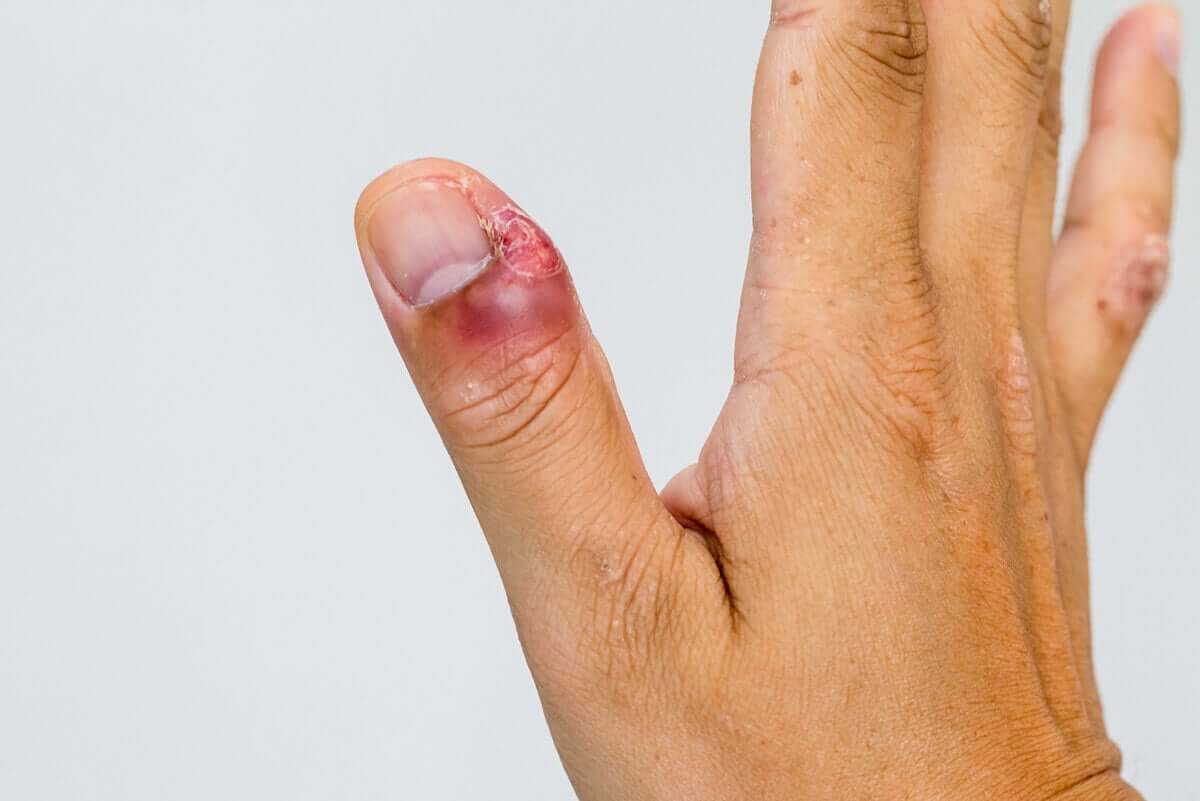 Infekcję wokół paznokci mogą powodować bakterie lub grzyby. Jej natężenie bywa różne.
