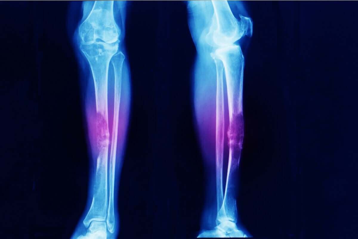 Mięsaki kości i stawów to złośliwe guzy pojawiające się zwykle w okolicach kolan.