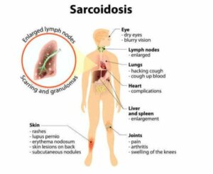 Sarkoidoza: na czym polega to schorzenie?
