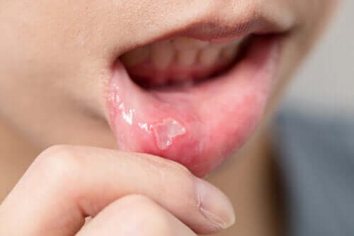 Afty w jamie ustnej u dzieci: jak je leczyć?