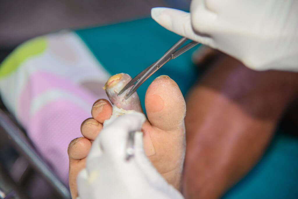 Operacja palca u stopy
