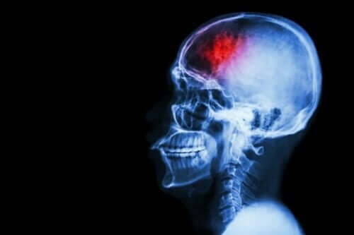 Jak chronić się przed udarem mózgu?