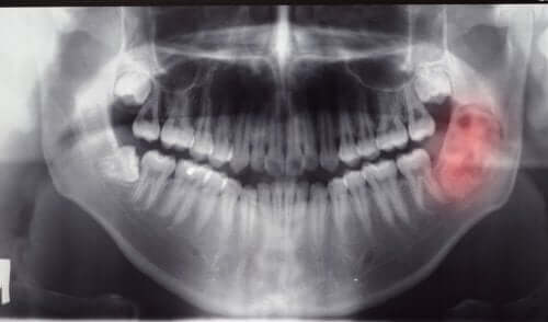 Guzy i cysty w jamie ustnej: diagnostyka