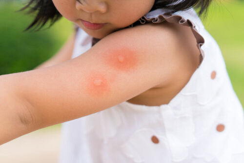 Dziecko pogryzione przez komary