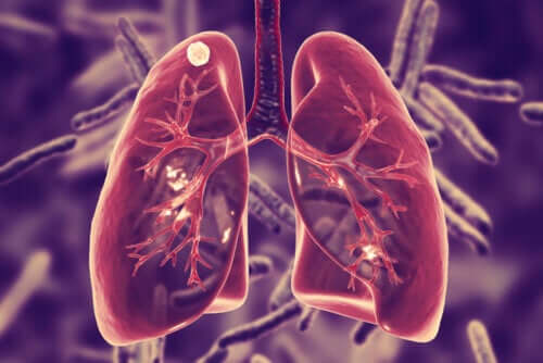 Gruźlica płuc – czym jest i jakie są jej objawy?