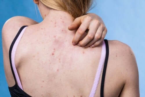 Choroby skóry – jak skutecznie im zapobiegać?
