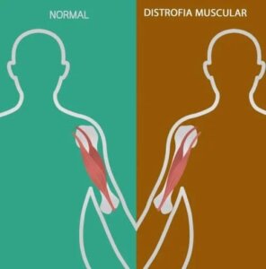 Zaburzenia nerwowo-mięśniowe: oznaki i objawy