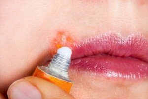 Opryszczka na ustach: objawy i leczenie