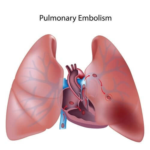 Choroba zakrzepowo-zatorowa płuc – wszystko, co musisz wiedzieć