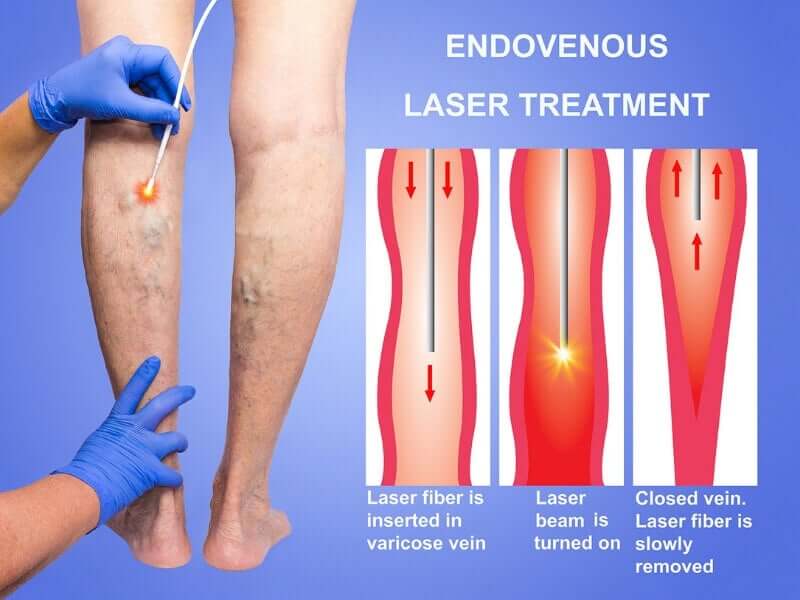 daflon a skleroterapia