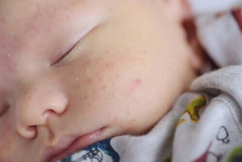 Jak leczyć ciemieniuchę i trądzik niemowlęcy?