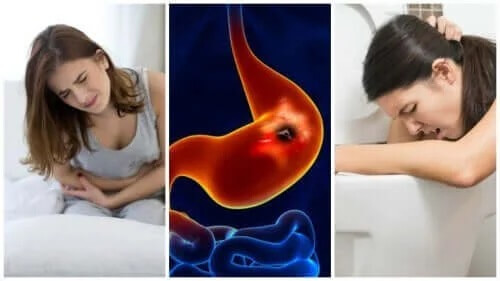 Wrzody układu pokarmowego