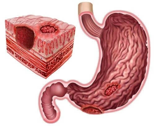 Wrzody układu pokarmowego i Helicobacter pylori