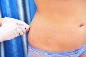 Co to jest lipoliza iniekcyjna i w jakim celu się ją stosuje?